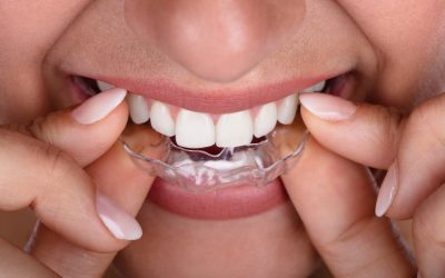 Gouttière bruxisme : la solution pour dormir en paix