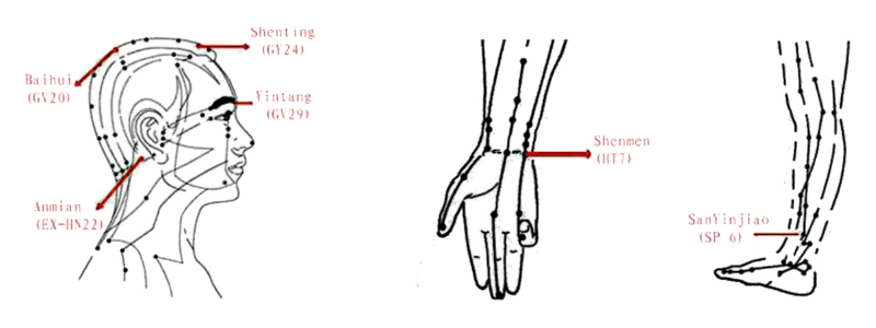 Acupression et acupuncture pour mieux dormir acupuncture pour mieux dormir